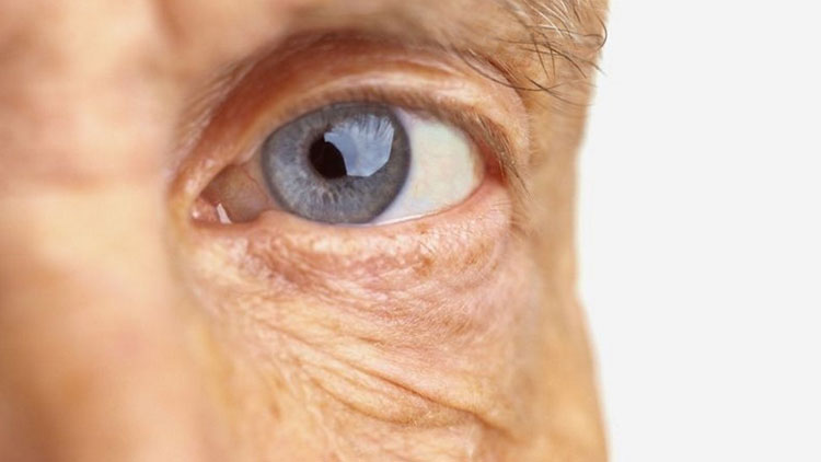 سارکوئیدوز چشم؛ علل و روش‌های تشخیص و درمان