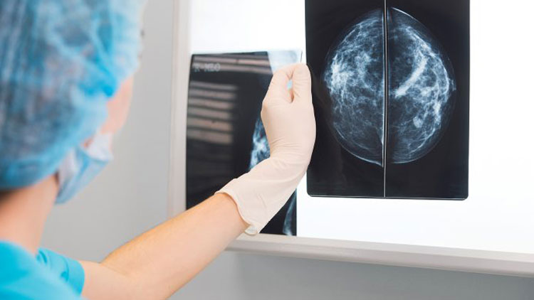 دورنمایی از ایمنی سرطان پستان