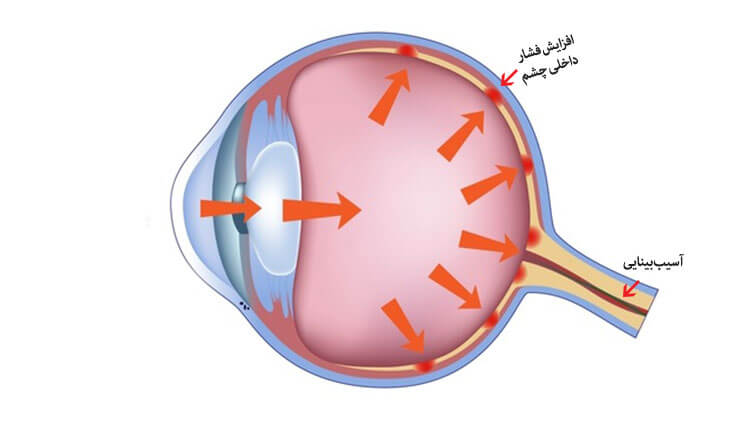فشار چشم؛ یکی از شایع‌ترین بیماری‎‌های چشم در عصر حاضر