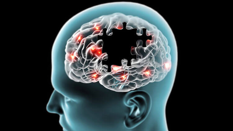 کشف انسداد عروق خونی مغز، راهی را برای درمان آلزایمر