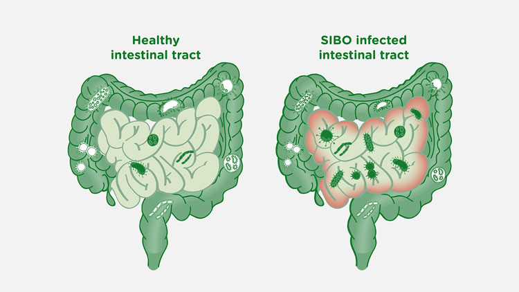 بررسی دلایل و علائم رشد زیاد باکتری‌های روده کوچک (SIBO)