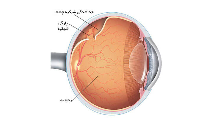 جداشدگی (پارگی) پرده شبکیه – Retinal Detachment