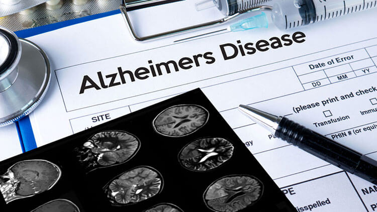 دگرگونی بیماری آلزایمر در سلول‌های انسانی