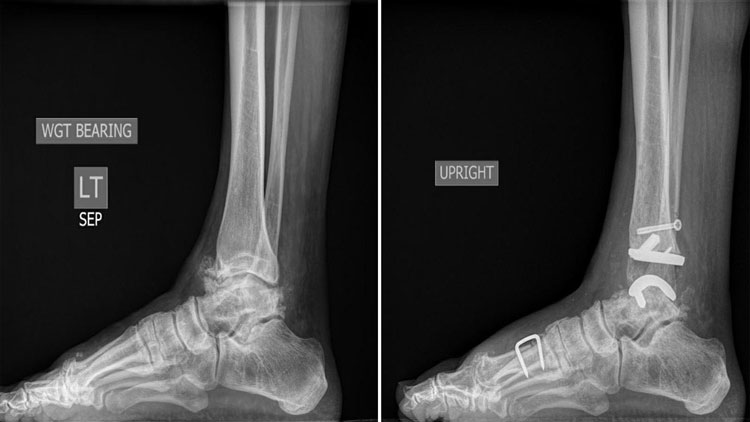 تازه‌ترین یافته‌ها در جایگزینی قوزک پا