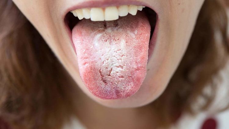 ده درمان طبیعی برای برفک دهان