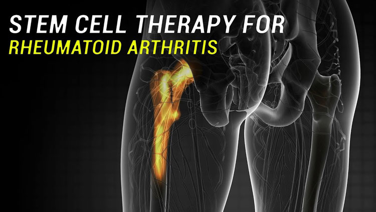 درمان سلول‌های بنیادی امیدی برای بیماران آرتریت روماتوئید ایجاد می‌کند