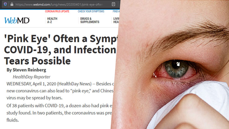 یکی دیگر از نشانه‌های بیماری ویروس کرونا « عارضه چشم صورتی» می‌باشد که عفونت از طریق اشک است.