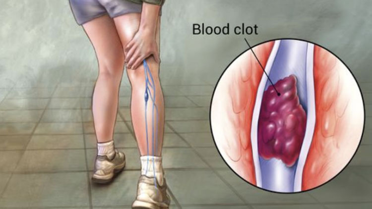 علائم لخته شدن خون: چگونه می‌توان گفت که لختگی خون دارید یا خیر؟