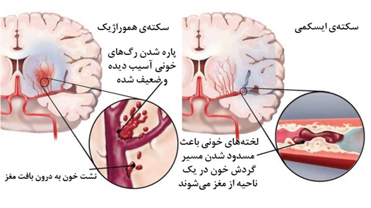 نقش طب فیزیکی در بازتوانی جسمی بعد از سکته مغزی