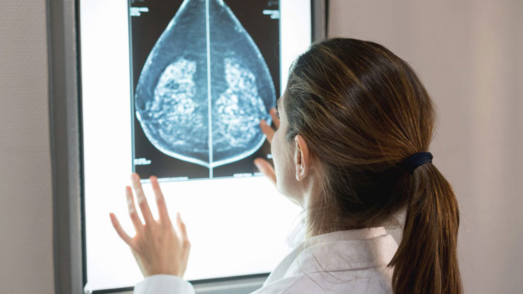 درباره سرطان پستان متاستاتیک در ۵۰ سالگی چه باید بدانید