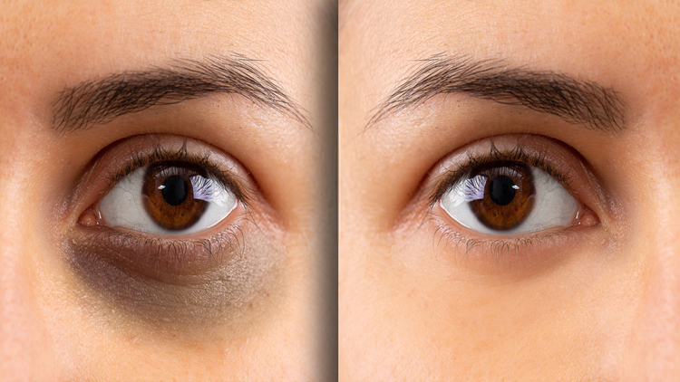چه چیزی باعث ایجاد حلقه‌های تیره زیر چشم شما می‌شود؟