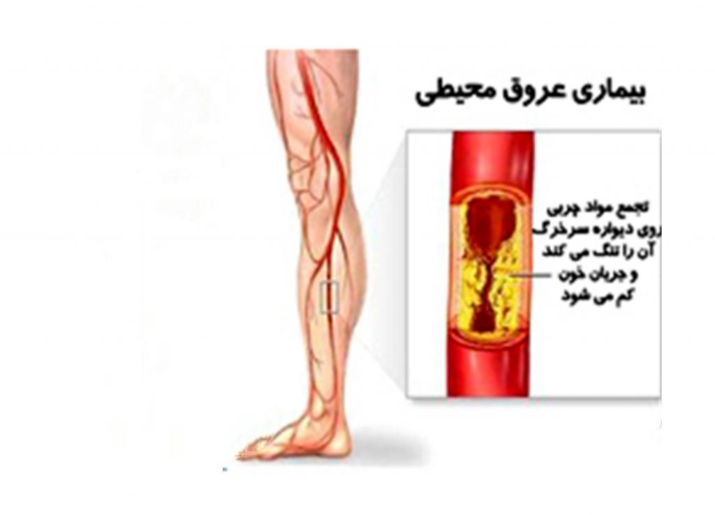 بیماری عروق محیطی خطرناک است