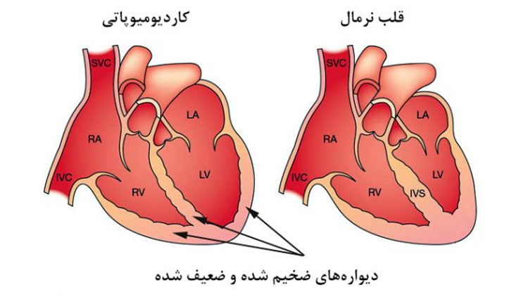کاردیومیوپاتی (بیماری عضله قلب)
