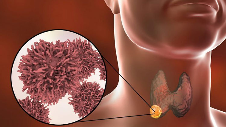 سرطان تیروئید چیست و چگونه درمان می‌شود؟
