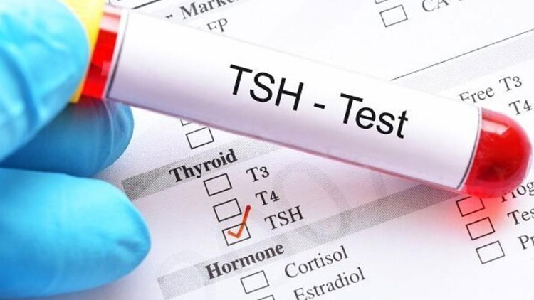 آزمایش تیروئید (TSH)؛ راهنمای خواندن برگه آزمایش و تحلیل نتیجه آن