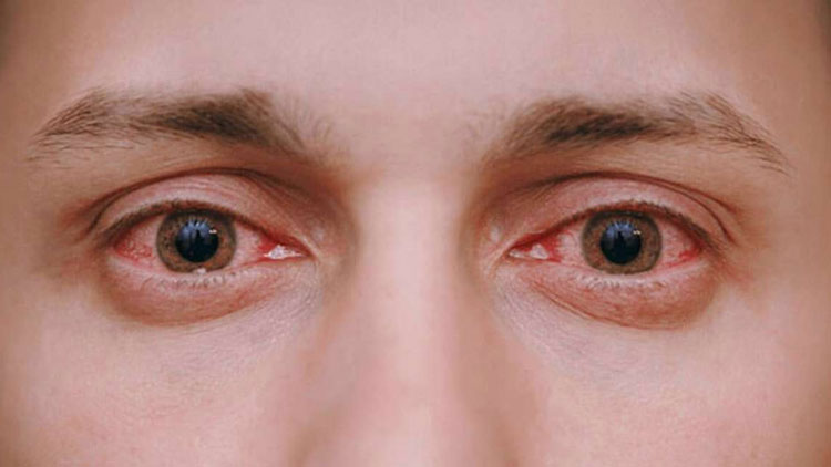 قرمزی چشم‌ها چه زمانی خطرناک است؟