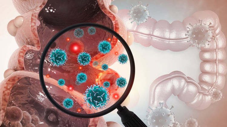 ریختن DNA سرطانهای روده بزرگ به شیمیدرمانی جریان خون