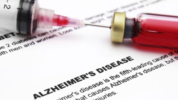 آزمایش خون جدید می‌تواند بیماری آلزایمر را ۳۰ سال زودتر تشخیص دهد.