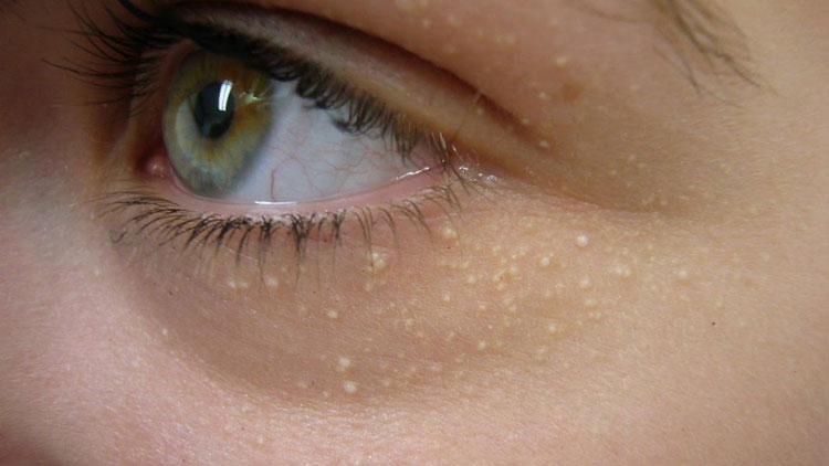 علت بروز و درمان دانه‌های چربی سفید رنگ زیر چشم