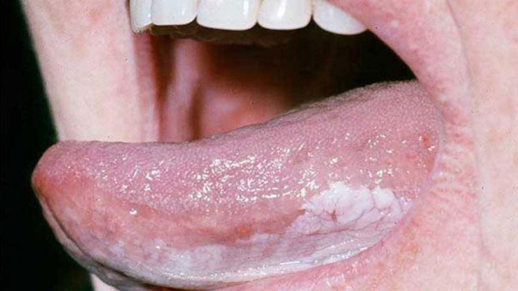 اطلاعاتی درباره سرطان زبان