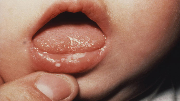 سوال و پاسخ (علل برفک دهان کودکان چیست؟)