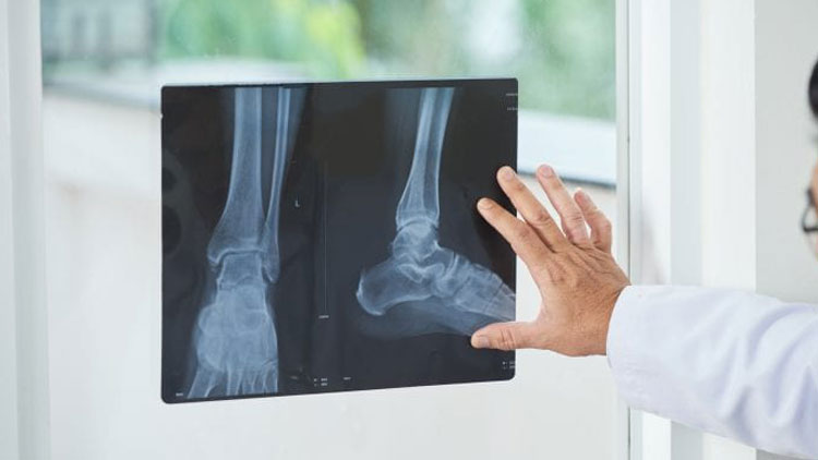 مکانیسم ترمیم استخوان می‌تواند کاربردهای درمانی جدیدی را ارائه دهد