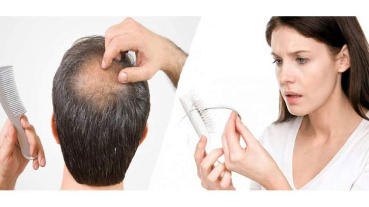 علت ریزش مو در زنان و مردان