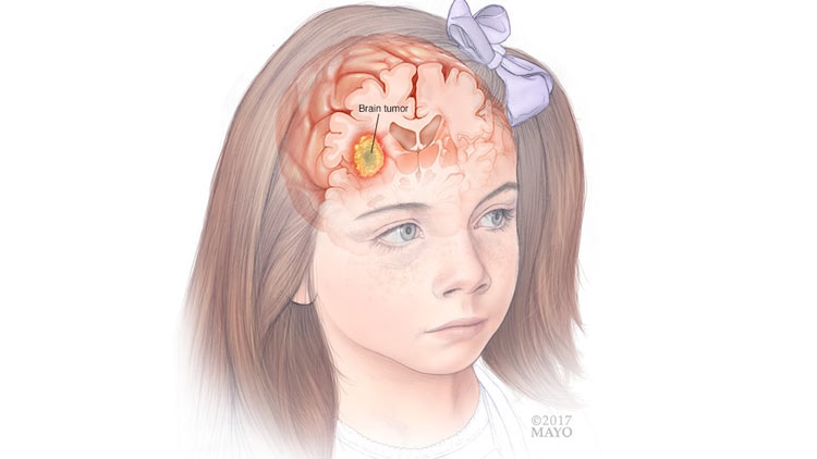 تومورهای مغزی کودکان از دیدگاه مایو کلینیک (Mayo Clinic)